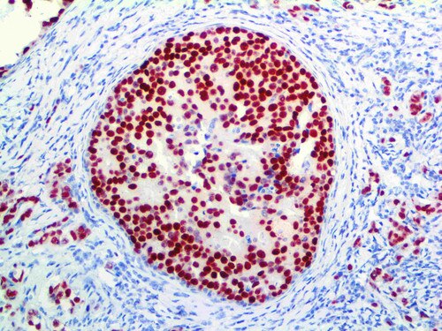 IHC of Estrogen Receptor on a FFPE Breast Carcinoma Tissue